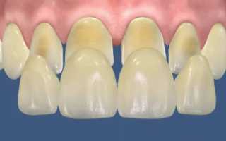 Как делается препарирование зуба под винир и какой способ лучше?