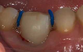 Актуально ли еще использование сепарационных колец в ортодонтии?