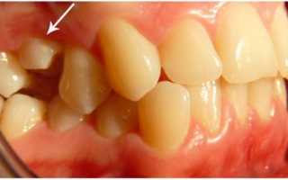 Особенности импактных зубов, причины их появления и способы исправления дефекта