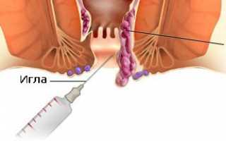 Как выполняют удаление геморроя?