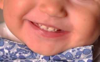 Опасности гипоплазии эмали зубов и схема устранения патологии