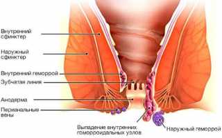 Как лечить внутренний геморрой?