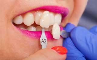 Насколько актуально исправление прикуса винирами в современной стоматологии