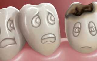 Стадии кариеса зубов: фото, симптомы, лечение