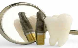 Бескровная имплантация – быстрое восстановление зубного ряда с минимальным дискомфортом
