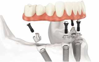 Комплексная имплантация зубов – быстрый и оптимальный способ восстановления элементов зубного ряда