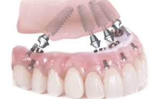Подробно обо всех тонкостях и способах проведения имплантации зубов без синус-лифтинга
