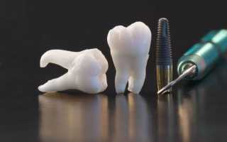Все самое важное об имплантации зубов с немедленной нагрузкой