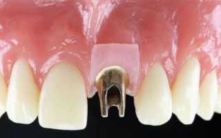 Регламент имплантации передних зубов