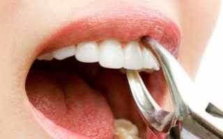 Как можно остановить кровь после удаления зуба?