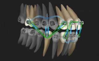 Специфика перестройки костной ткани при перемещении зубов
