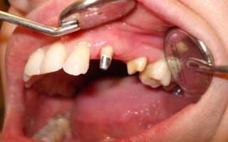 О возможности эффективного протезирования зубов с низкими коронками
