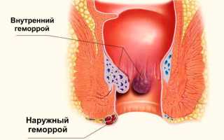 Разновидности диагностики и лечения наружного и внутреннего геморроя