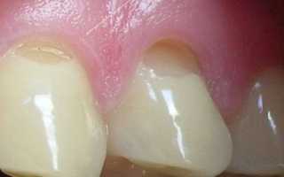 Клиновидный дефект зуба: этиология, признаки, фото