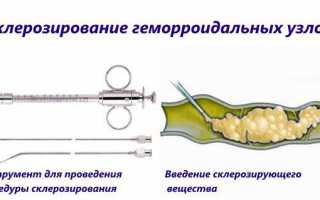 При геморрое болит копчик -может ли такое быть и что с этим делать?