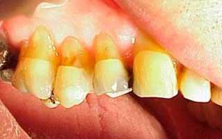 Все подробности про лечение клиновидного дефекта зубов