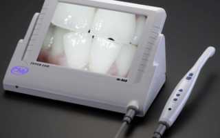 Что нового привнесли в стоматологию интраоральные камеры?