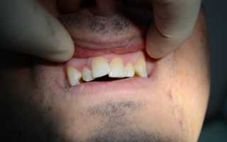 Этиология скученности зубов и способы реконструкции дефекта
