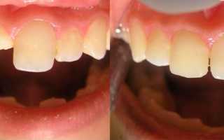 Какие проблемы решают световые пломбы на передних зубах