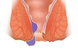 Диагностика и перечень методов лечения наружного геморроя