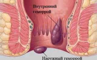 Малоинвазивная технология лигирования геморроидальных узлов