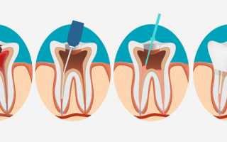 Что такое пульпит зуба и чем он опасен