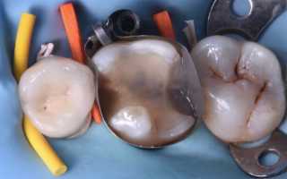 Методика Deep Margin Elevation для реставрации зубов