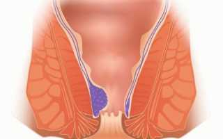 Диагностика и лечение первой степени геморроя