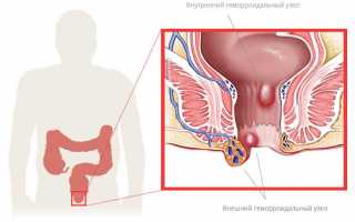 Эффективные методы лечения геморроя в домашних условиях