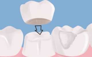 Коронки на зубы – какие лучше поставить