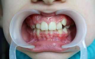 Симптомы, диагностика и коррекция супраокклюзии зубов