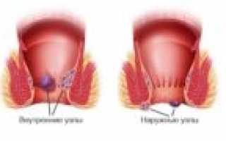 Как в домашних условиях самостоятельно вправить геморрой?