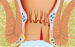 ТОП — 5 отличий трещины от геморроя