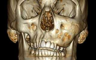 Дисплазия челюсти — что это и насколько опасна патология