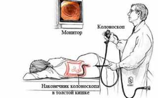 Колоноскопия кишечника — рекомендации и подготовка