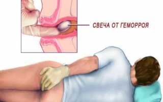Как правильно использовать ректальные свечи при геморрое?