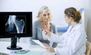 Чем опасен остеопороз во время постменопаузы?