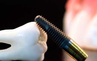 Этапы имплантации зубов классическим способом