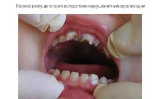 Причины развития зубов Гетчинсона и способы исправления аномалии