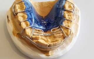 Биоблок в ортодонтии – современная технология выравнивания зубов без брекетов