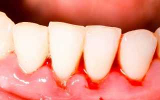Подробно о причинах появления крови из-под коронки зуба и тактике избавления от симптома