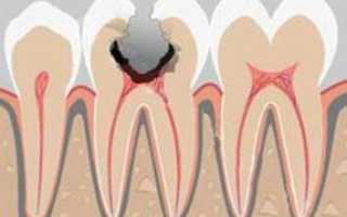 Не торопитесь удалять зуб при диагнозе «гипертрофический пульпит»