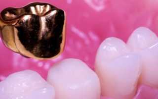 Золотые коронки на зубы – эффективное протезирование или неоправданная роскошь?