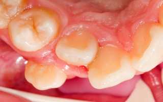 Насколько опасна транспозиция зубов и что можно предпринять