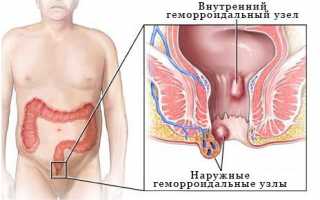 Лечение хронического геморроя: симптомы и причины