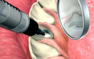 Секрет возвращения природного оттенка зубу с помощью внутриканального отбеливания