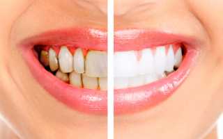 Зубной камень: причины возникновения и последствия