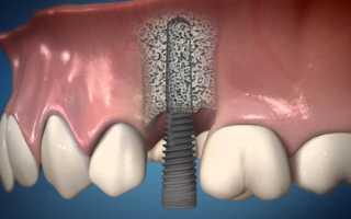Основания к проведению компрессионной имплантации зубов