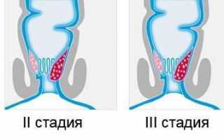 Лечение геморроя 2 стадии – основные методы борьбы