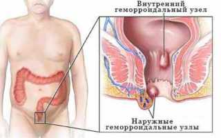 Диагностика и методы лечения геморройных узлов